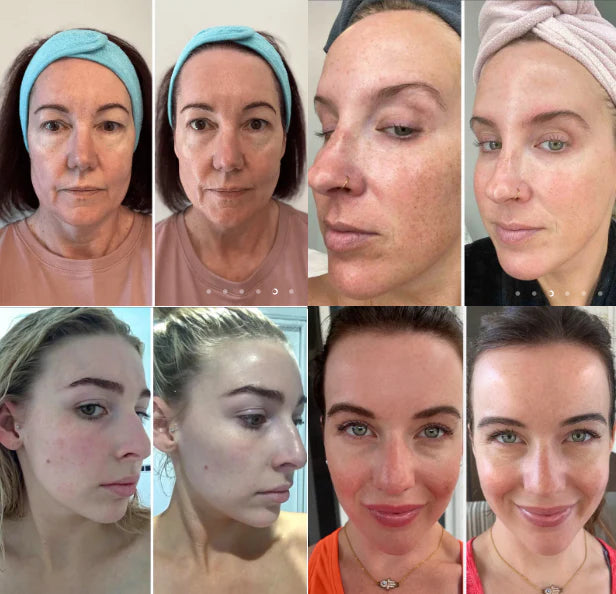 BiocollagenPlus - Máscara absorvível de colágeno + ativos do botox.